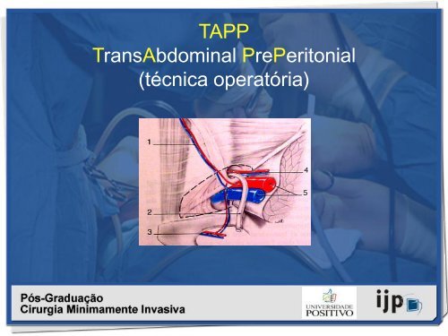 HÃ©rnia Inguinal a TAPP - IJP