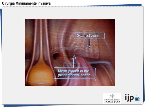 HÃ©rnia Inguinal a TAPP - IJP