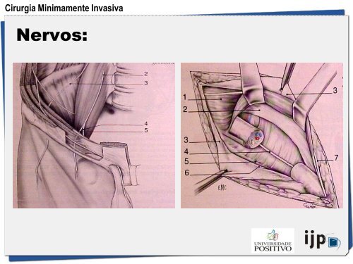 HÃ©rnia Inguinal a TAPP - IJP