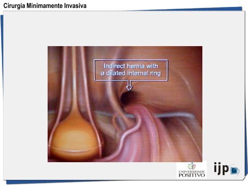 HÃ©rnia Inguinal a TAPP - IJP