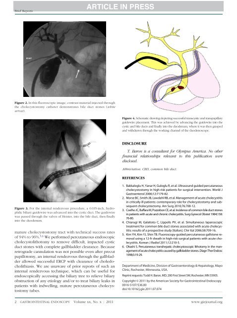 Percutaneous cholecystoscopy and internal rendezvous for ... - IJP