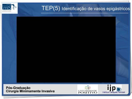 Hernioplastia inguinal TÃ©cnica TEP - IJP