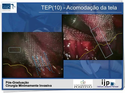 Hernioplastia inguinal TÃ©cnica TEP - IJP