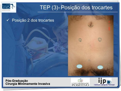 Hernioplastia inguinal TÃ©cnica TEP - IJP