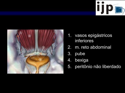 Anatomia CirÃºrgica Aplicada HÃ©rnia Inguinal LaparoscÃ³pica - IJP