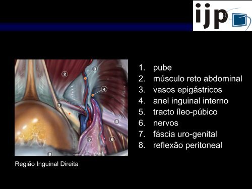 Anatomia CirÃºrgica Aplicada HÃ©rnia Inguinal LaparoscÃ³pica - IJP