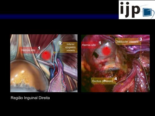 Anatomia CirÃºrgica Aplicada HÃ©rnia Inguinal LaparoscÃ³pica - IJP