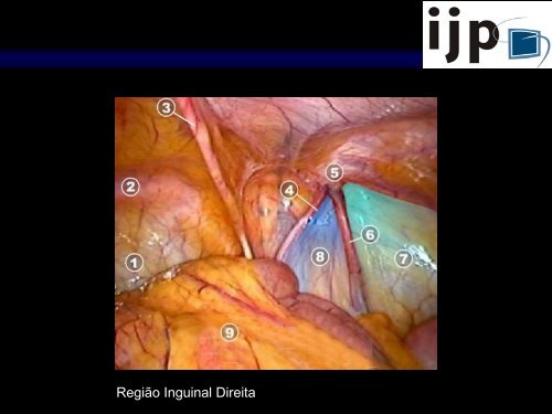 Anatomia CirÃºrgica Aplicada HÃ©rnia Inguinal LaparoscÃ³pica - IJP