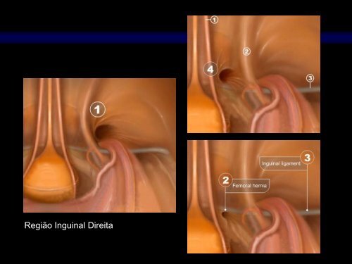 Anatomia CirÃºrgica Aplicada HÃ©rnia Inguinal LaparoscÃ³pica - IJP