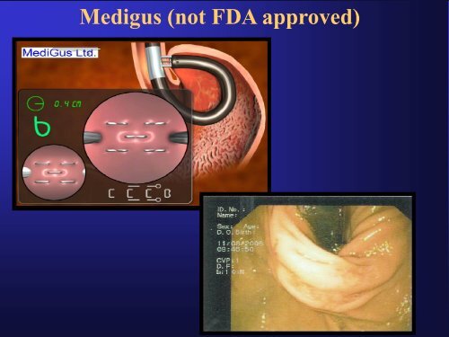 Resultados Fundoplicatura a Longo Prazo - IJP