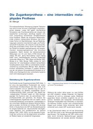 M. Menge - Implantat - Atlas Zementfreie HÃ¼ftpfannen