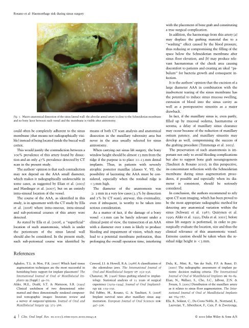 Maxillary sinus vascular anatomy and its relation to sinus lift surgery
