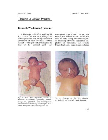 PDF Format - Indian Pediatrics