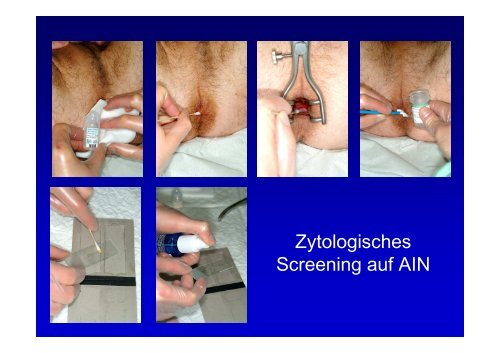 Potthoff_HPV Screening bei HIV-infizierten Patienten