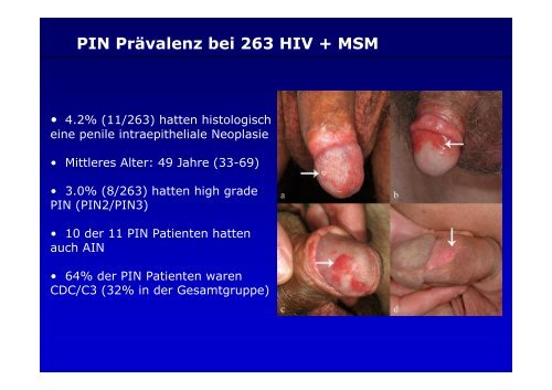 Potthoff_HPV Screening bei HIV-infizierten Patienten