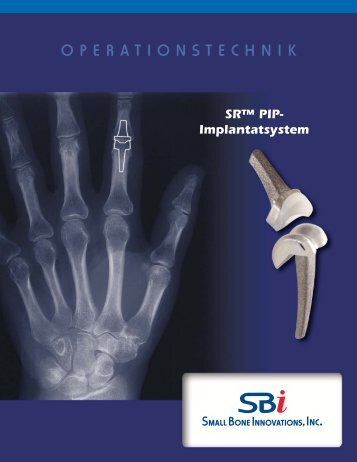 Download Surgical Technique - Small Bone Innovations