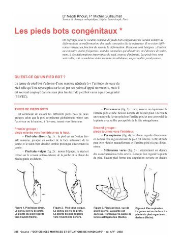 Les pieds bots congÃƒÂ©nitaux - Moteurline - APF