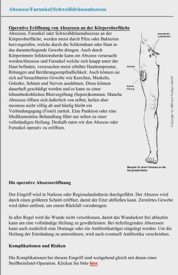 Abszesse/Furunkel/Schweißdrüsenabszesse - Chirurgie Heidelberg