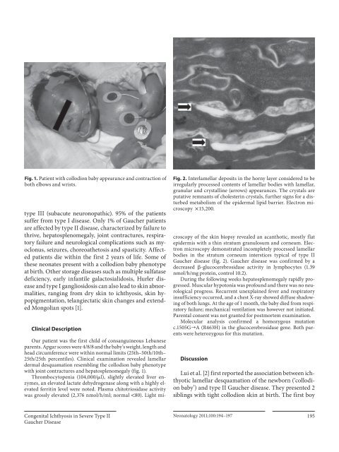 Congenital Ichthyosis in Severe Type II Gaucher Disease with a ...