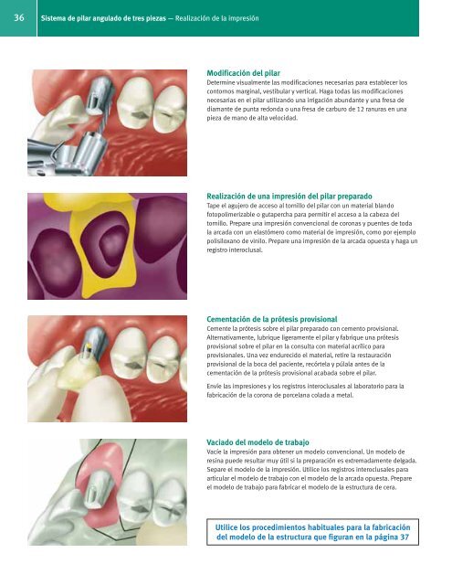 Manual de restauraciÃƒÂ³n protÃƒÂ©sica con Tapered ... - Zimmer Dental