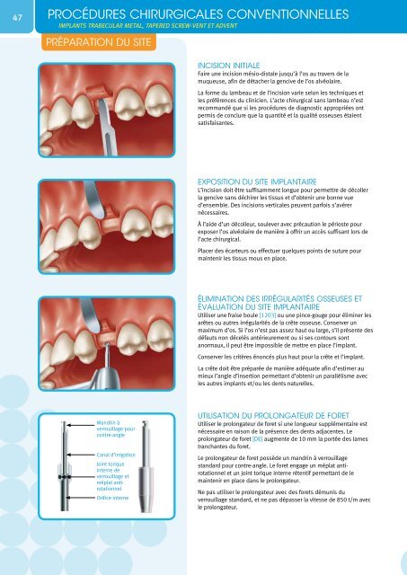 SystÃƒÂ¨me d'implants Tapered Screw-VentÃ‚Â® - Zimmer Dental