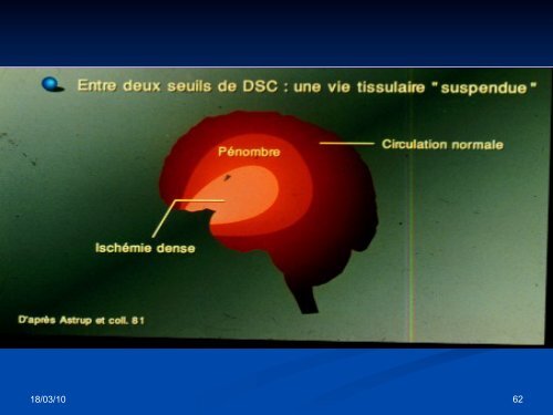 Accident Vasculaire Cérébral