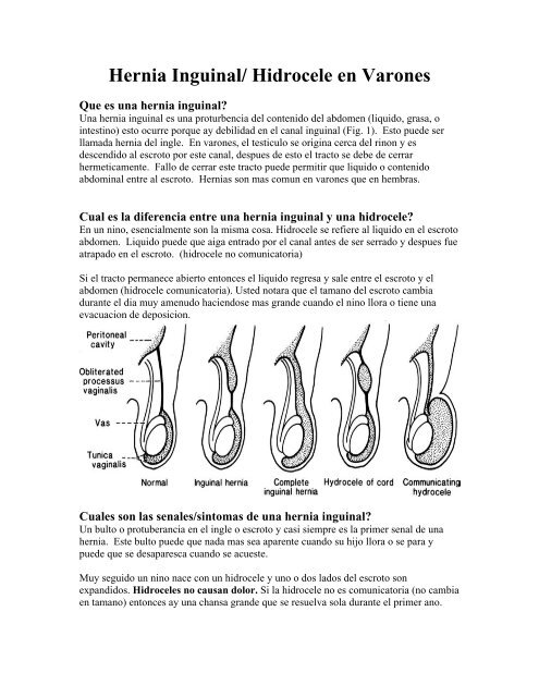 Inguinal hernia / hydrocele in males - OU Medicine