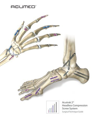 Acutrak 2 Headless Compression Screw System Surgical technique ...