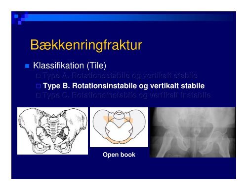 (Microsoft PowerPoint - B\346kken- og acetabulum)