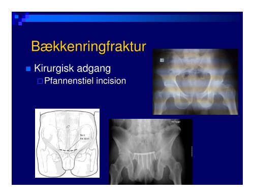 (Microsoft PowerPoint - B\346kken- og acetabulum)