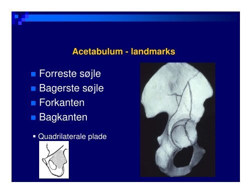 (Microsoft PowerPoint - B\346kken- og acetabulum)