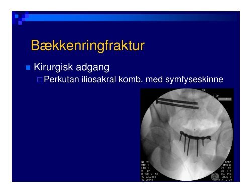 (Microsoft PowerPoint - B\346kken- og acetabulum)