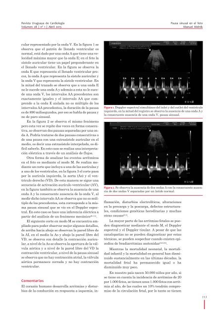 Pausa sinusal en el feto - Sociedad Uruguaya de CardiologÃ­a