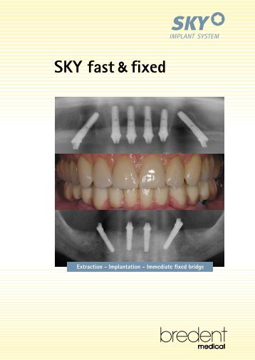 SKY fast & fixed - Bredent.co.uk