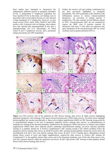 2. spongiotic dermatitis with a mixed - Our Dermatology Online Journal