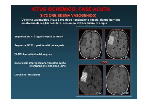 ICTUS ISCHEMICO: FASE IPE