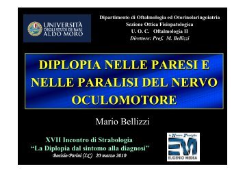 Diplopia nelle paresi e nelle paralisi del nervo oculomotore