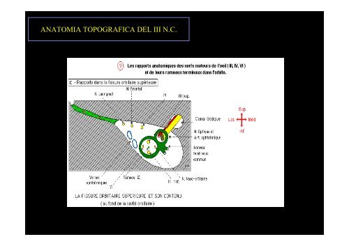 Diplopia nelle paresi e nelle paralisi del nervo oculomotore