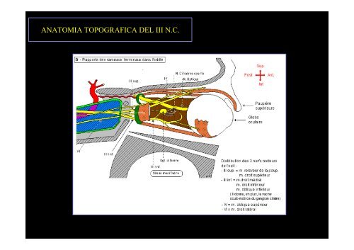 Diplopia nelle paresi e nelle paralisi del nervo oculomotore