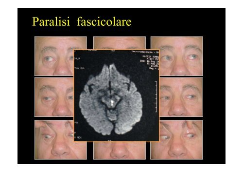 Diplopia nelle paresi e nelle paralisi del nervo oculomotore