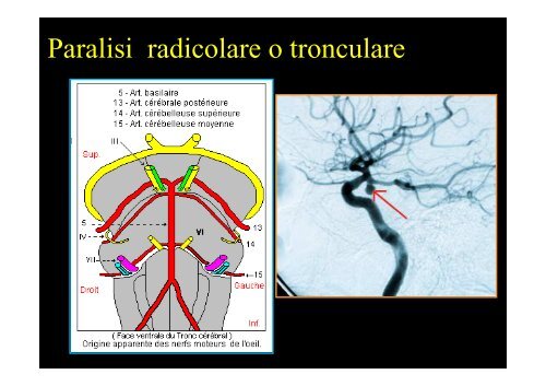 Diplopia nelle paresi e nelle paralisi del nervo oculomotore