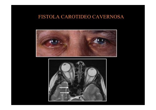 Diplopia nelle paresi e nelle paralisi del nervo oculomotore