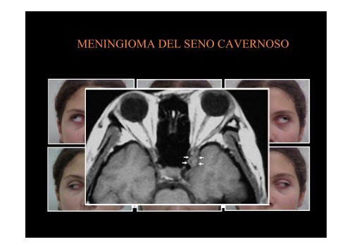 Diplopia nelle paresi e nelle paralisi del nervo oculomotore