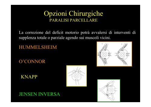 Diplopia nelle paresi e nelle paralisi del nervo oculomotore