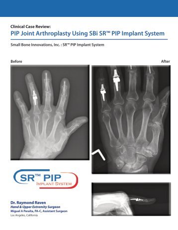 Download the SRâ¢ PIP Case Study Brochure - Small Bone ...