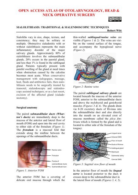 Sialolithiasis Traditional And Sialendoscopic Techniques Vula