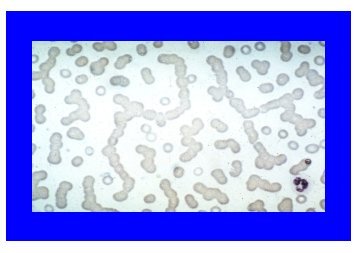 10-20% der IgA-Myelome - Plasmozytom / Multiples Myelom ...