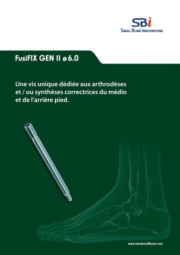 FusiFIXâ¢ GEN II Ã¸ 6.0 - Small Bone Innovations