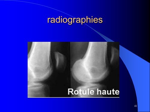 MESOTHERAPIE et GENOU