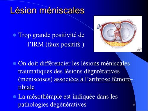 MESOTHERAPIE et GENOU